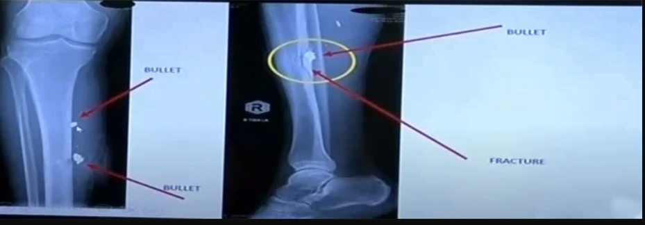 mage showing an X ray of Khans shin